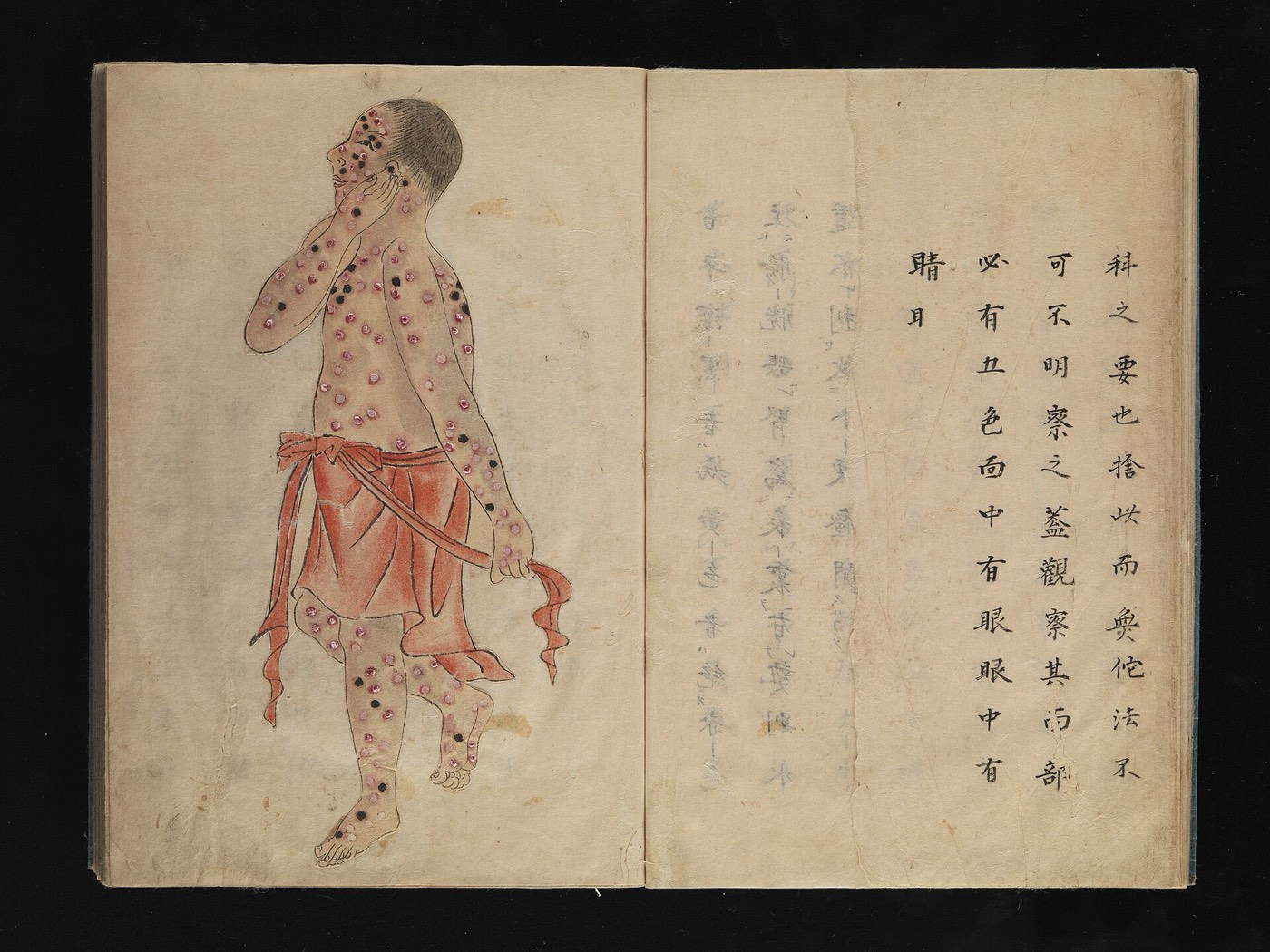 疱瘡の発疹が出た子どもを描いた江戸期の医学写本の彩色図